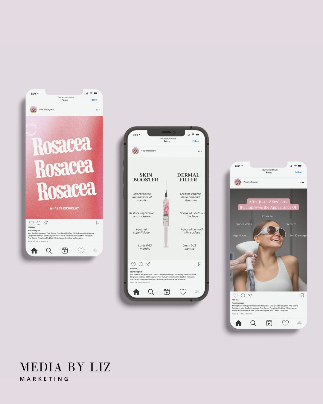 Editable Instagram post templates for estheticians and injectors highlighting skincare education, filler info, rosacea awareness, and IPL treatment benefits — created to boost engagement and visibility on social media.


