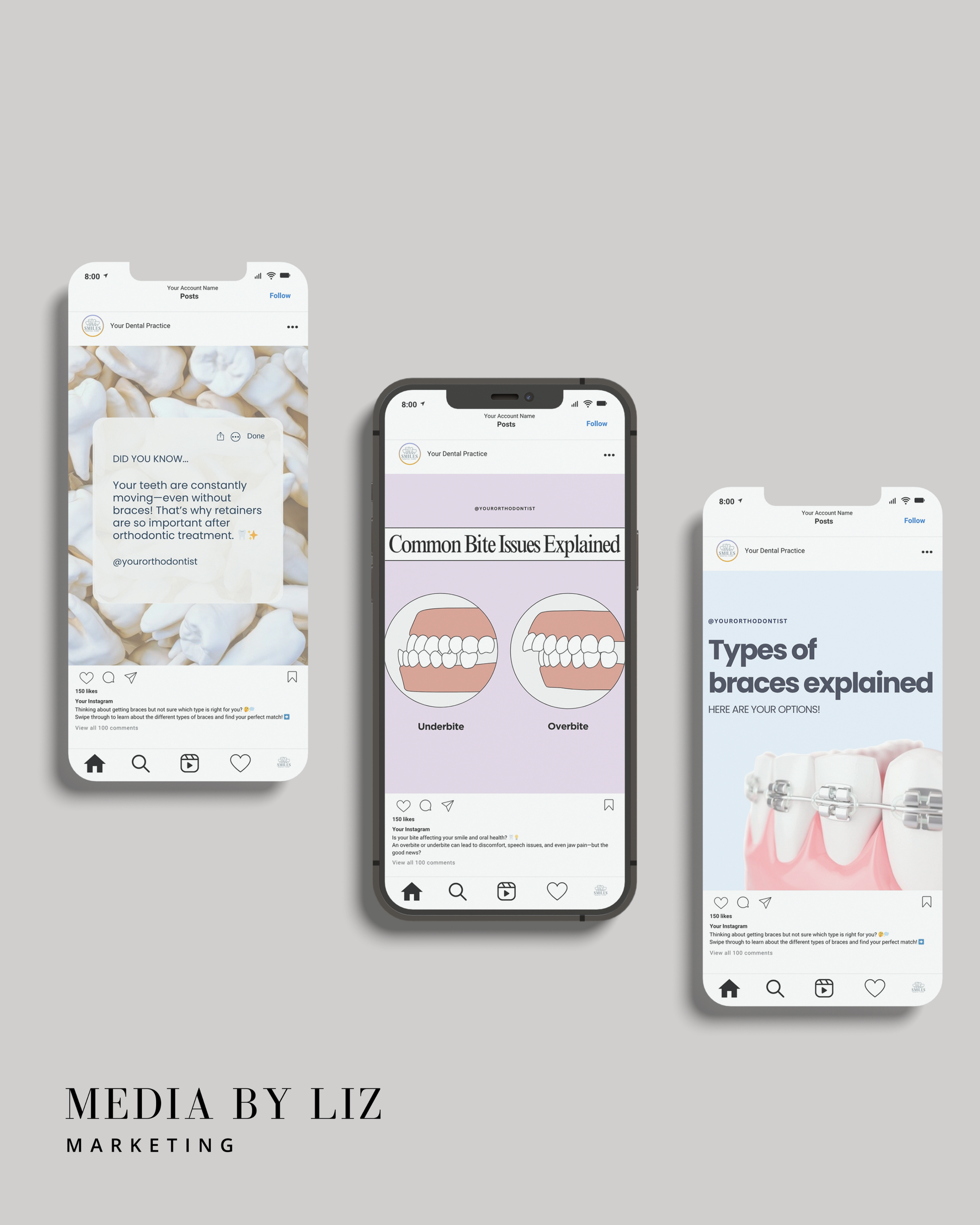 Instagram post mockups for orthodontists featuring educational content on retainers, bite issues, and types of braces — part of a Canva template kit designed to grow dental practice engagement on social media.