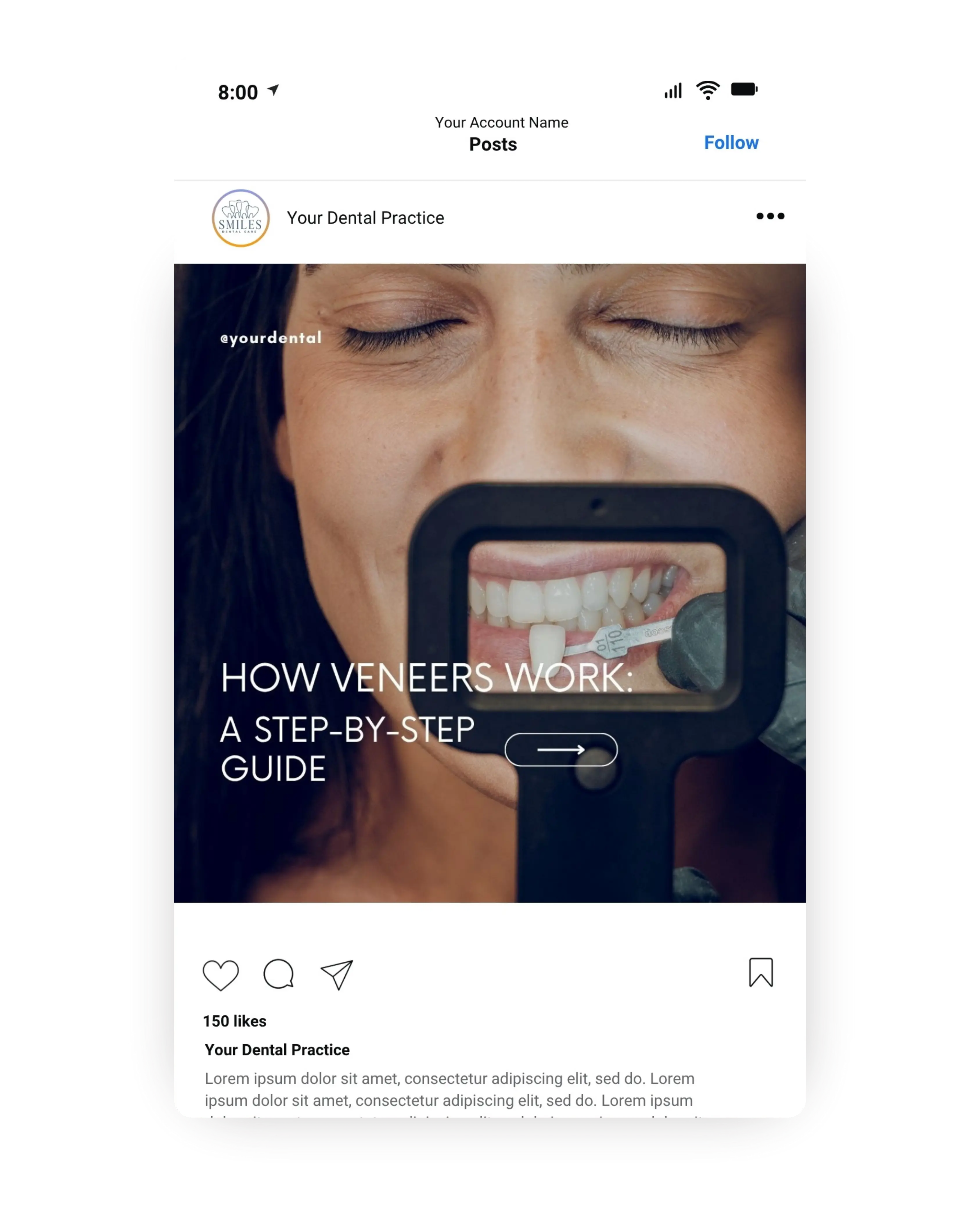 Cosmetic dentistry educational template showing woman smiling while dentist holds veneer shade guide, explaining how veneers work step by step for dental marketing